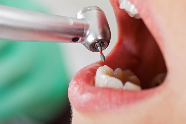 Best Lost Filling or Crown Replacement in Sherrelwood, CO